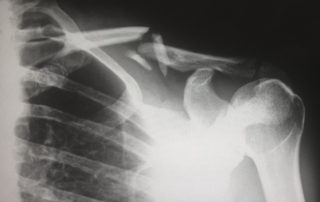 x-ray of a broken collarbone