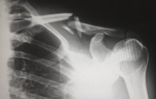x-ray of a broken collarbone