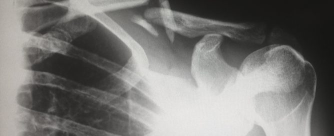 x-ray of a broken collarbone