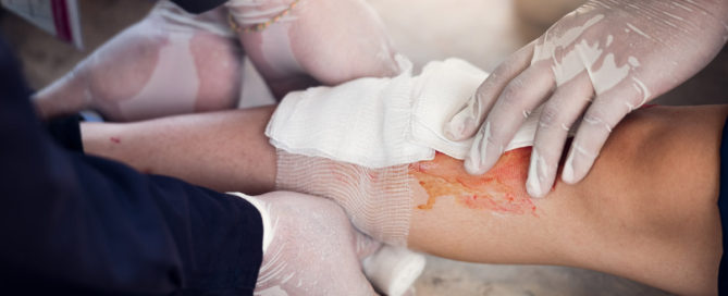 two people wearing medical gloves putting gauze on a bloody shin